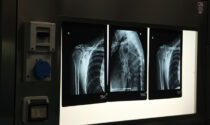 Patologie della spalla: visite specialistiche e interventi chirurgici