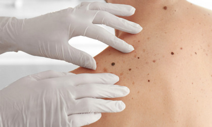 Salva la tua pelle: campagna di prevenzione del melanoma cutaneo